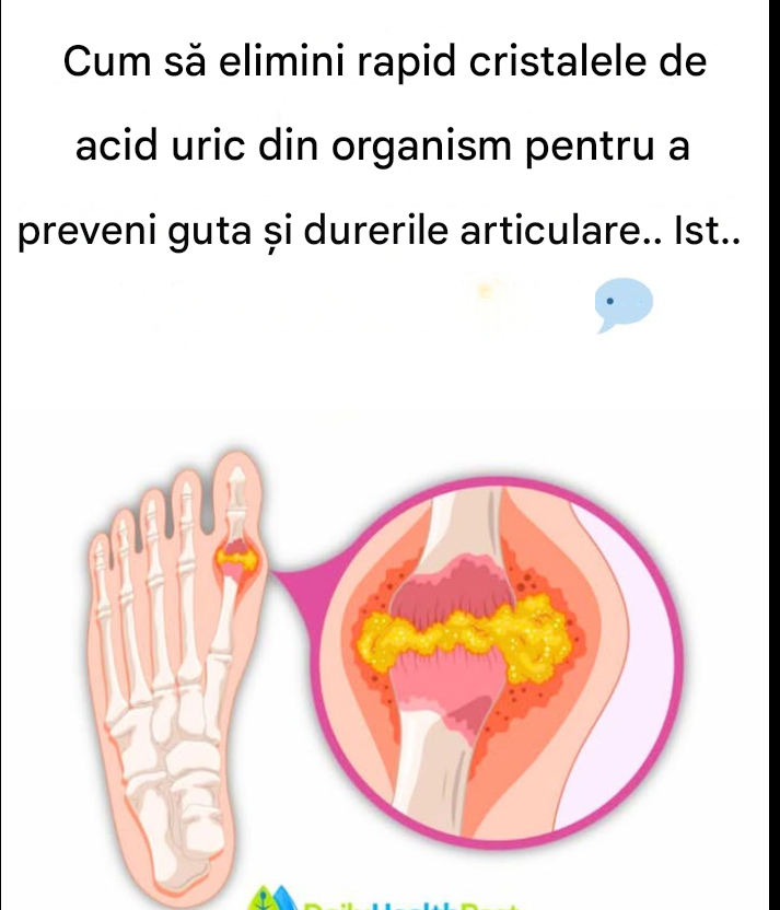 Cum să elimini rapid cristalele de acid uric din organism pentru a preveni guta și durerile articulare