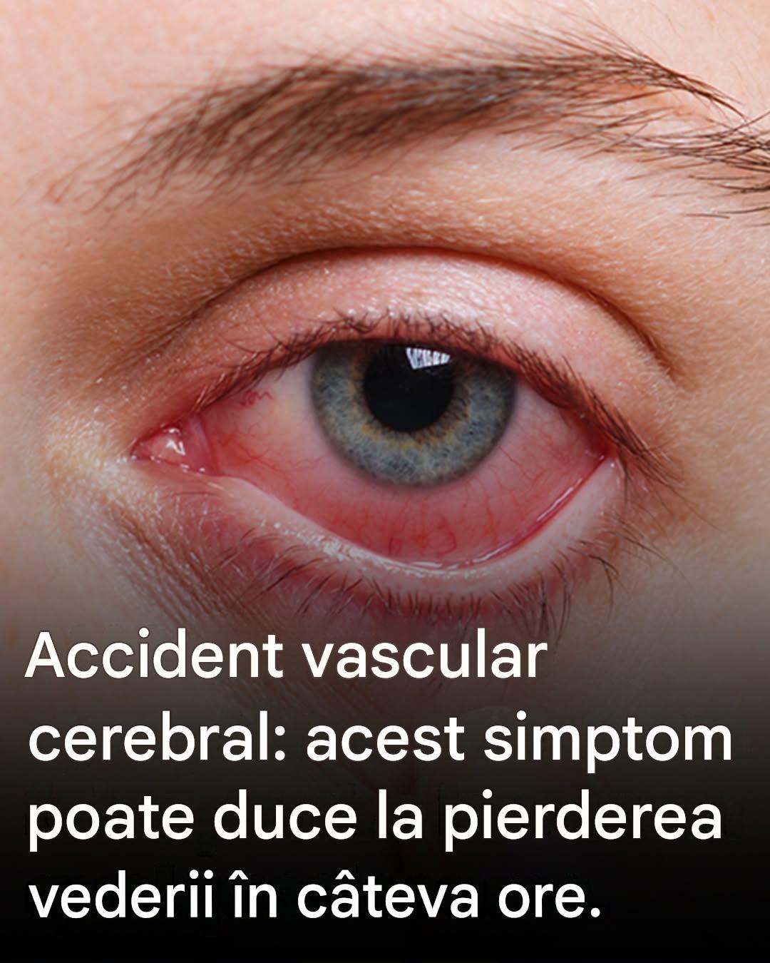 Accident vascular cerebral al ochiului: acest simptom poate duce la pierderea vederii în câteva ore