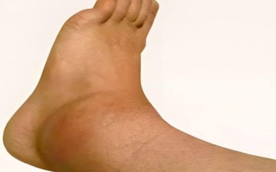 Glezne și picioare umflate: iată cauzele!