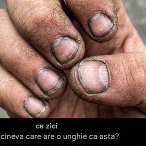 Cum se numește o persoană cu astfel de unghii?