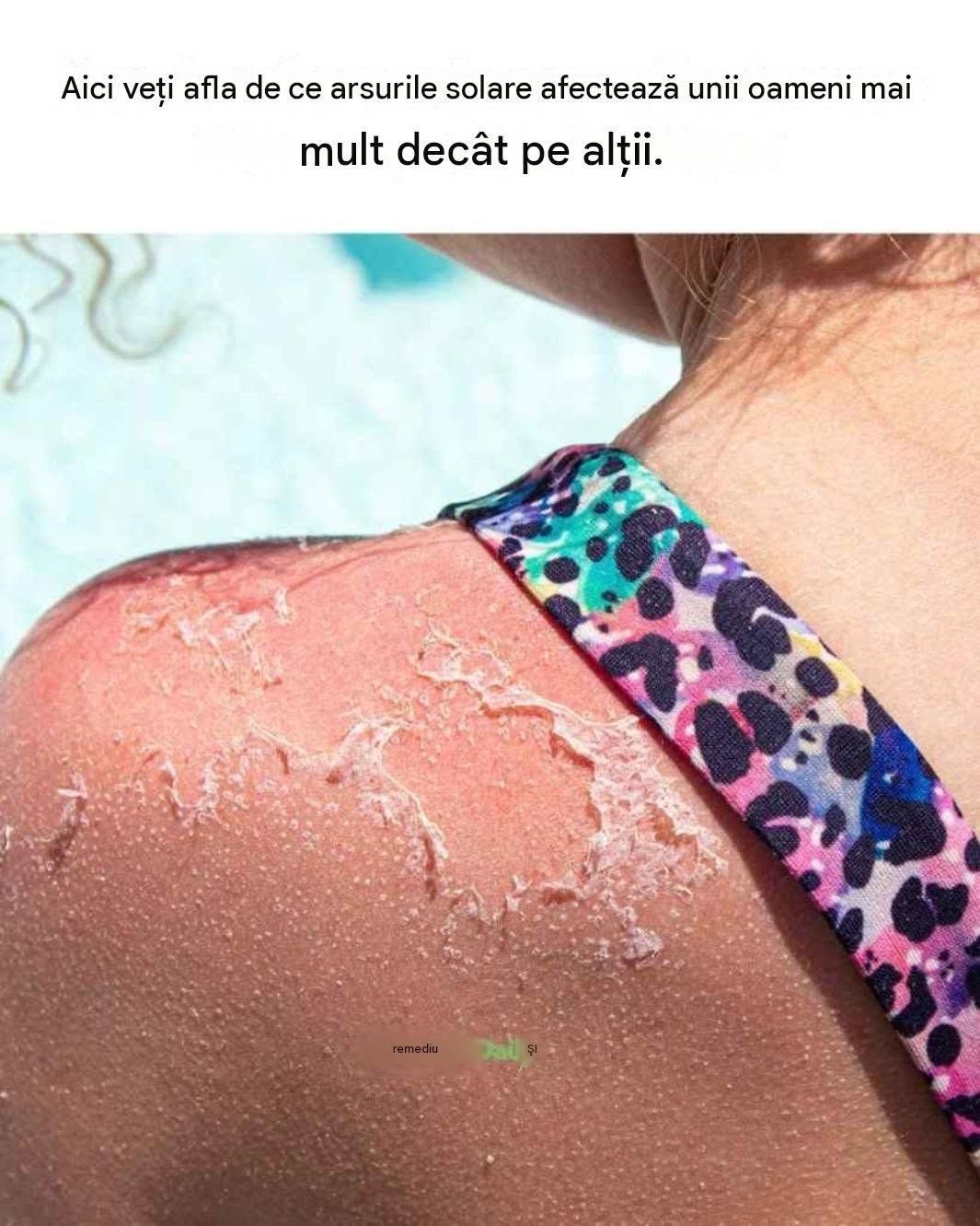 De ce unii oameni se ard ușor la soare