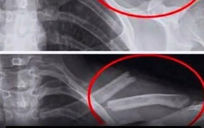 Băutura care distruge oasele din interior spre exterior și provoacă…  Detalii în primul comentariu